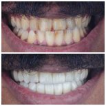 Hollywood Smile Vorher-Nachher-Ergebnis bei Omara Dental Centers – weiße, gerade Zähne