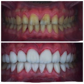 Hollywood Smile Vorher-Nachher-Ergebnis bei Omara Dental Centers – weiße, gleichmäßige Zähne