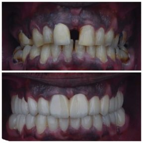 Vorher-nachher-Ergebnis Zirkonbrücke bei Omara Dental Centers, Lächeln wiederhergestellt