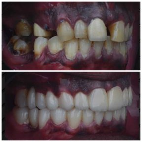 Vorher-nachher-Ergebnis Zirkonbrücke bei Omara Dental Centers, Lächeln wiederhergestellt