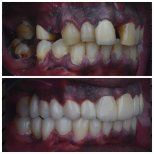 Vorher-nachher-Ergebnis Zirkonbrücke bei Omara Dental Centers, Lächeln wiederhergestellt