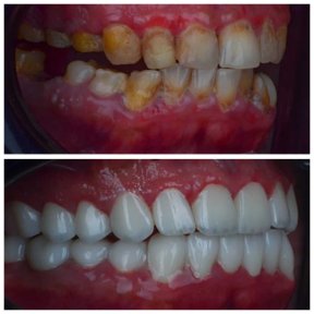Vorher-nachher-Ergebnis Hollywood Smile Veneers bei Omara Dental Centers – deutliche Veränderung