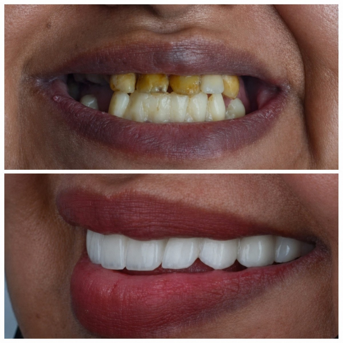 Resultado antes y después de implantes All-on-6 en Omara Dental Centers, sonrisa mejorada