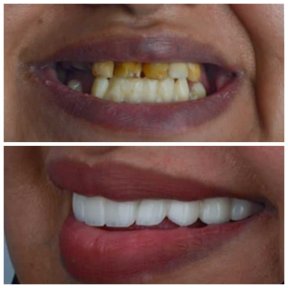 Результат до и после имплантации All-on-6 в Omara Dental Centers, улучшенная улыбка