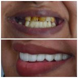 Результат до и после имплантации All-on-6 в Omara Dental Centers, улучшенная улыбка