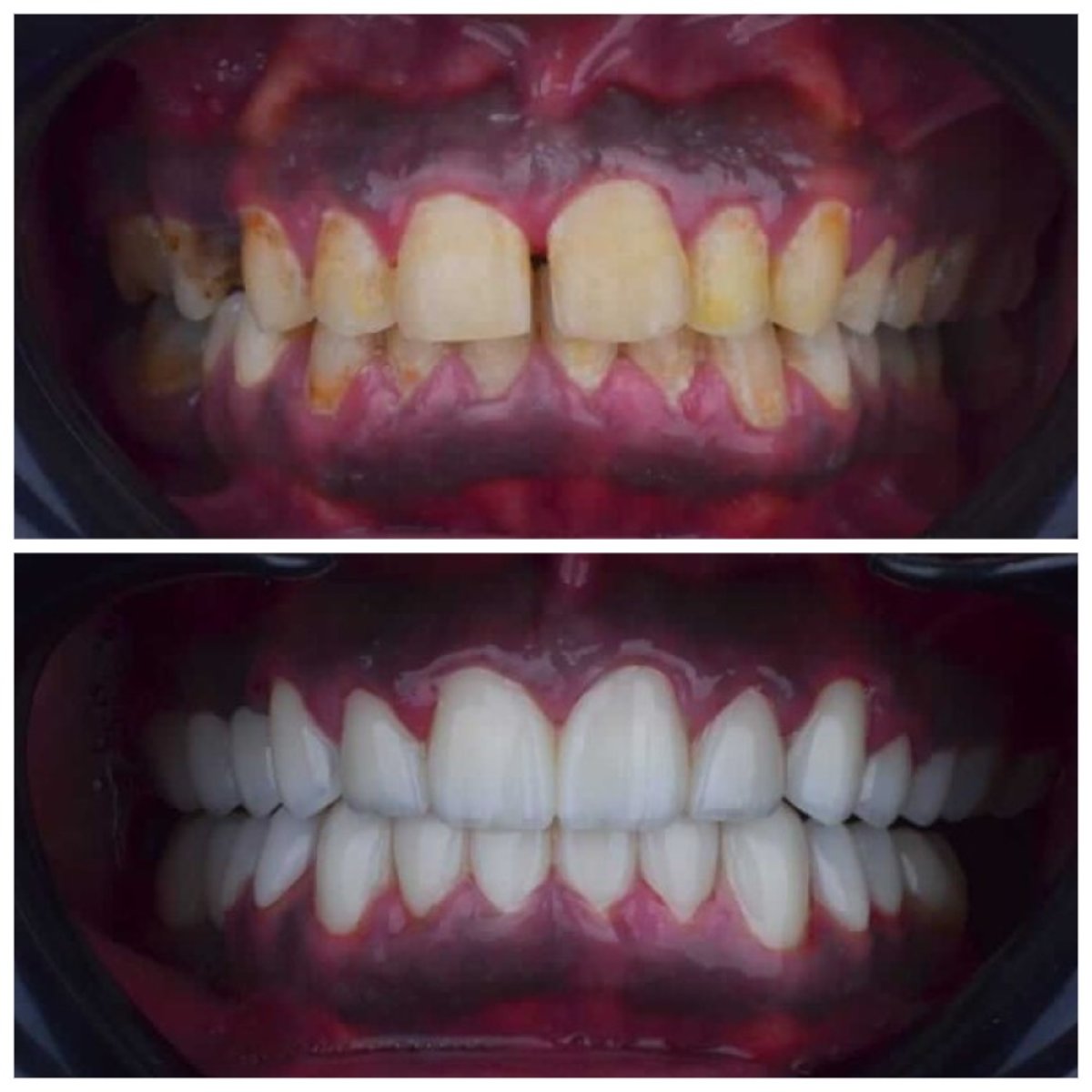 Vorher-nachher-Veneers bei Omara Dental Centers – natürlich wirkendes Lächeln