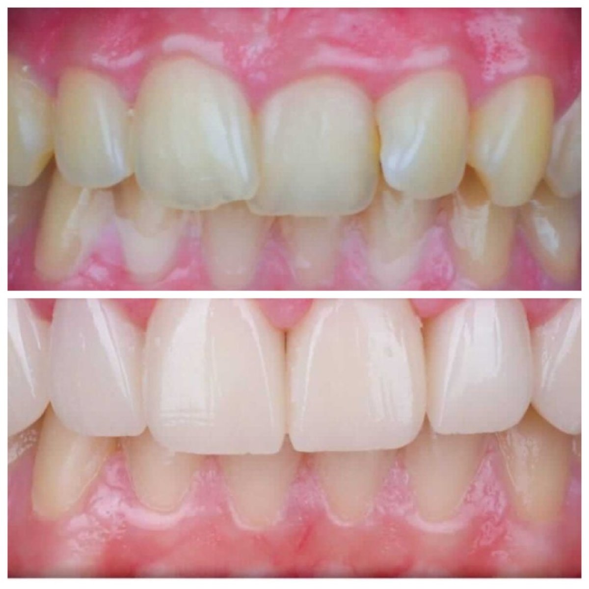 Vorher-nachher-Veneers bei Omara Dental Centers – strahlendere Zähne und neues Lächeln