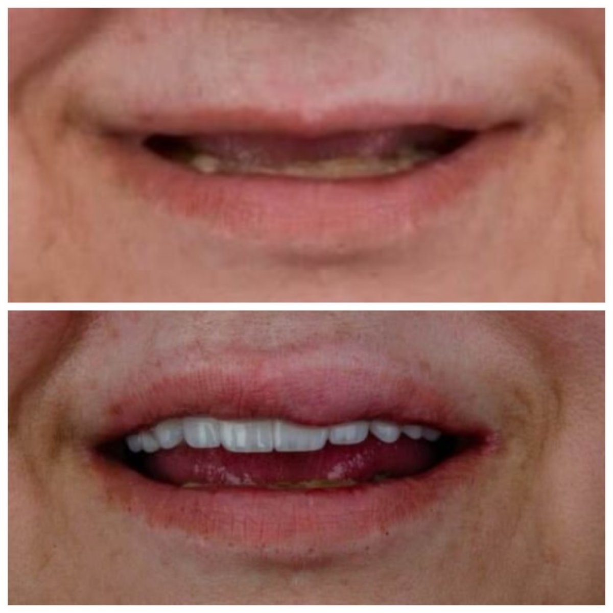 Resultado antes y después de implantes dentales All-on-6 en Omara Dental Centers, sonrisa restaurada