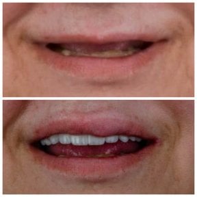 Before and after All-on-6 dental implants result at Omara Dental Centers, restored smile