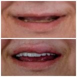 Before and after All-on-6 dental implants result at Omara Dental Centers, restored smile