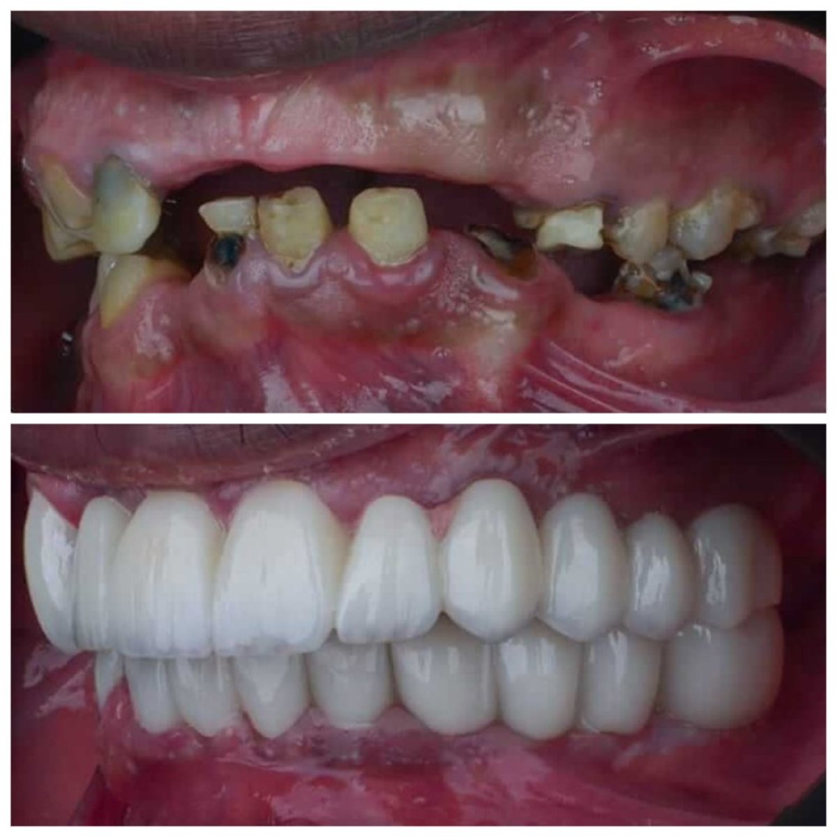 Resultados antes y después de implantes All-on-6 en Omara Dental Centers, sonrisa restaurada