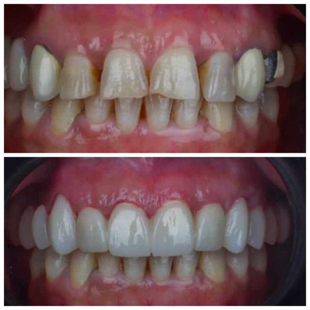 Vorher-nachher-Veneers bei Omara Dental Centers – natürliches Lächeln-Ergebnis