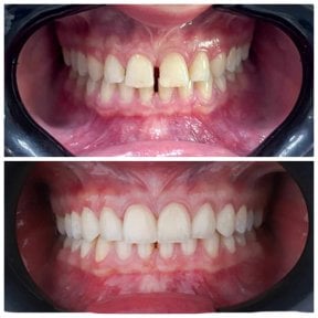 До та після встановлення вініров в Omara Dental Centers – вирівнювання та зміна посмішки
