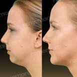 Vorher-nachher-Ergebnis Kinn-Liposuktion bei Memorial Şişli Hospital, verbesserte Kinnlinie