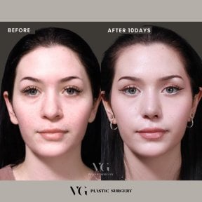 Результаты ринопластики кончика носа в VG Plastic Surgery, форма носа через 10 дней
