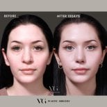 Результаты ринопластики кончика носа в VG Plastic Surgery, форма носа через 10 дней