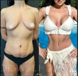 Vorher-nachher Brustimplantate mit Straffung bei Liv Hospital Ulus, verbesserte Kontur