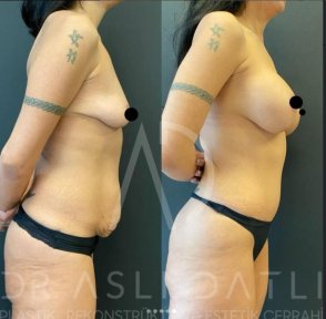 Vorher-nachher Brustimplantate mit Straffung bei Liv Hospital Ulus, verbessertes Ergebnis