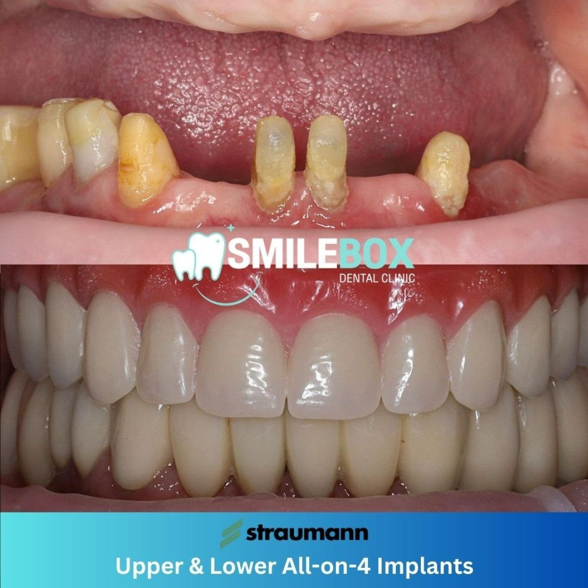 نتيجة قبل وبعد زراعة أسنان All-on-4 في SmileBox Dental Clinic - Thonglor