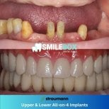 Before and after All-on-4 dental implants result at SmileBox Dental Clinic - Thonglor branch