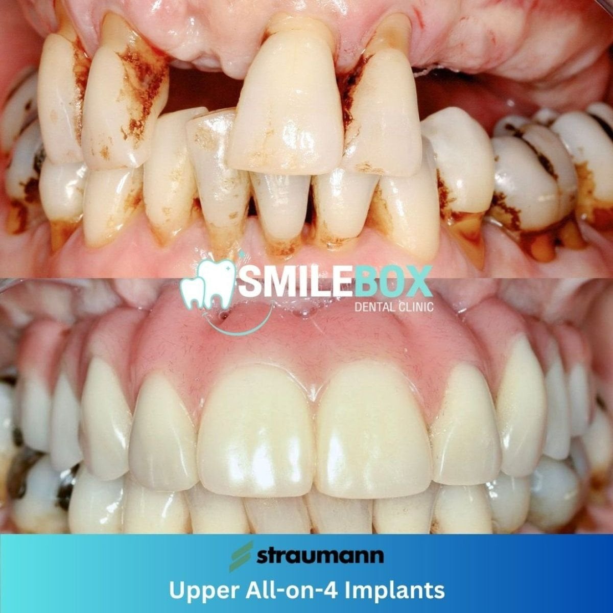 نتائج قبل وبعد زراعة الأسنان All-on-4 العلوية في SmileBox Dental Clinic Thonglor