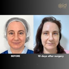 Facelift before and after results at ID Clinic Bangkok, visible facial rejuvenation in 10 days