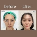 Before and after chin implant results at ID Clinic Bangkok, enhanced chin contour visible