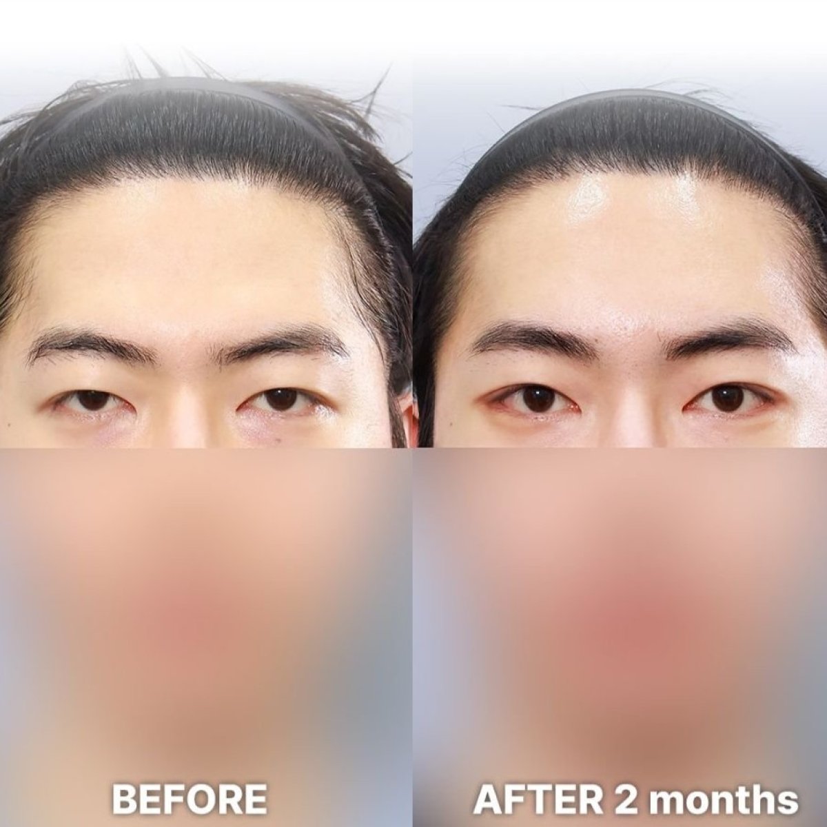 نتائج عملية الجفن المترهل قبل وبعد في Returning Plastic Surgery بعد شهرين