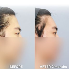 Vorher-nachher-Ergebnis Lidstraffung bei Returning Plastic Surgery, 2 Monate postoperativ