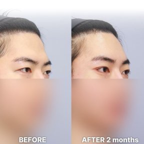 Vorher-nachher-Ergebnis der Schlupflid-OP bei Returning Plastic Surgery, 2 Monate post-op