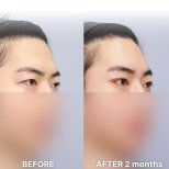 Vorher-nachher-Ergebnis der Schlupflid-OP bei Returning Plastic Surgery, 2 Monate post-op