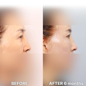 Vorher-nachher-Ergebnis Lidstraffung bei Returning Plastic Surgery, Verbesserung nach 6 Monaten