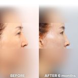 Vorher-nachher-Ergebnis Lidstraffung bei Returning Plastic Surgery, Verbesserung nach 6 Monaten