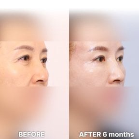 Vorher-nachher-Ergebnis Lidstraffung bei Returning Plastic Surgery, 6 Monate postoperativ