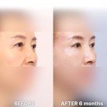 Vorher-nachher-Ergebnis Lidstraffung bei Returning Plastic Surgery, 6 Monate postoperativ