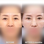 Ergebnis der Schlupflid-OP nach 6 Monaten bei Returning Plastic Surgery