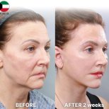 Vorher-nachher-Ergebnis Lidstraffung bei Returning Plastic Surgery, sichtbare Augenlifting