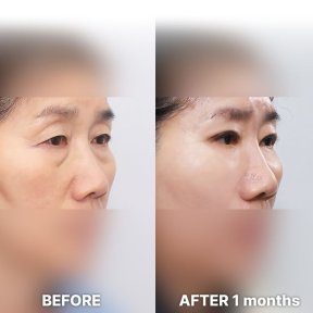 Vorher-nachher-Ergebnis der Schlupflid-OP bei Returning Plastic Surgery, verbesserte Augenkontur