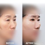Vorher-nachher-Ergebnis der Schlupflid-OP bei Returning Plastic Surgery, verbesserte Augenkontur