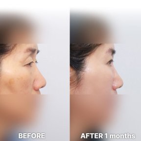 Vorher-nachher-Ergebnis Lidstraffung bei Returning Plastic Surgery, verbesserte Lidkontur