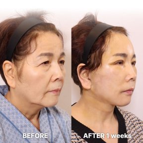 Результаты мини-подтяжки лица в Returning Plastic Surgery, видимое омоложение лица
