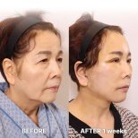 Результаты мини-подтяжки лица в Returning Plastic Surgery, видимое омоложение лица