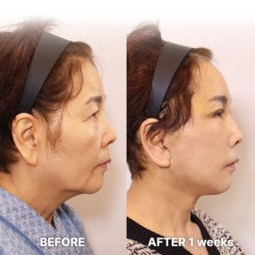 Результат мини-подтяжки лица до и после в Returning Plastic Surgery, видимый лифтинг овала