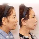 Результат мини-подтяжки лица до и после в Returning Plastic Surgery, видимый лифтинг овала