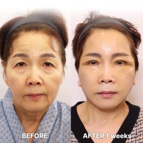 Результаты мини-подтяжки лица до и после в Returning Plastic Surgery, омоложение лица