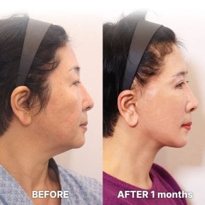 Результаты мини-подтяжки лица до и после в Returning Plastic Surgery, омоложение лица