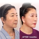 Результаты мини-подтяжки лица в Returning Plastic Surgery, видимое омоложение лица