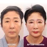 Результаты мини-лифтинга до и после в Returning Plastic Surgery, видимое омоложение лица