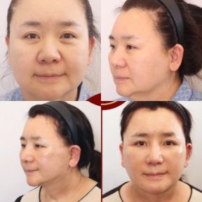 Результаты мини-подтяжки лица до и после в Returning Plastic Surgery, омоложение лица