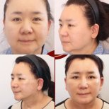 Результаты мини-подтяжки лица до и после в Returning Plastic Surgery, омоложение лица
